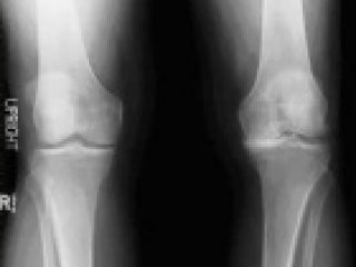 Virtual Knee Surgery - 2 